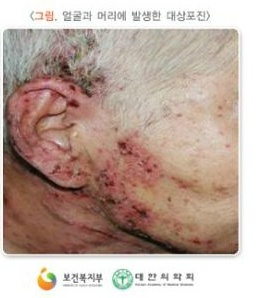 대상포진8.jpg