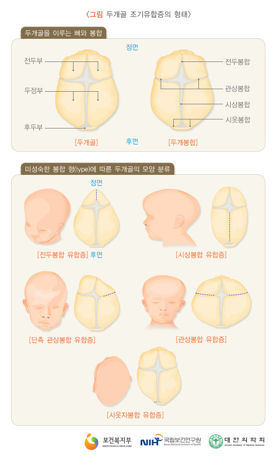 두개조기봉합.jpg