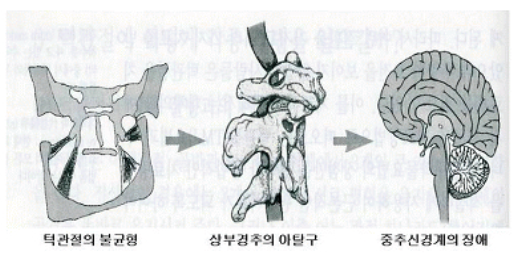 턱관절 불균형.png