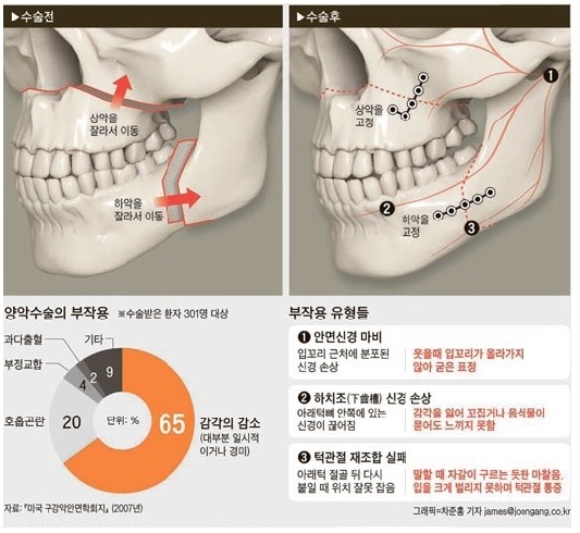 양악수술 부작용.jpg