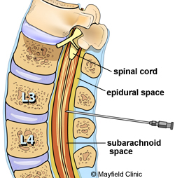 뇌수종5 PE-Lumbarpuncture_Fig1.jpg