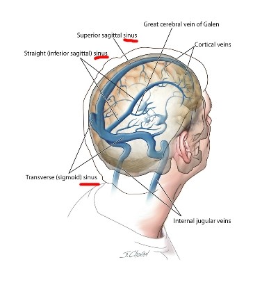 뇌수종7 image-1-cut2.jpg